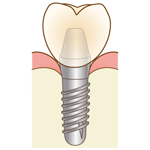 インプラント治療
